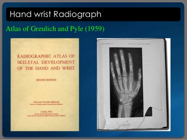 greulich and pyle bone age atlas